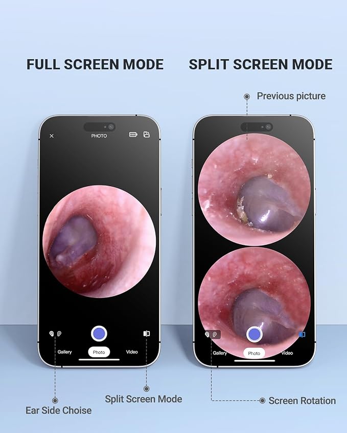 Wireless Otoscope with Gyroscope, Ear Camera with Dual View, 3.9 mm Otoscope with Light, Ear Scope with Ear Wax Removal Tool, Ear Cleaning Kit, Compatible with iPhone and Android