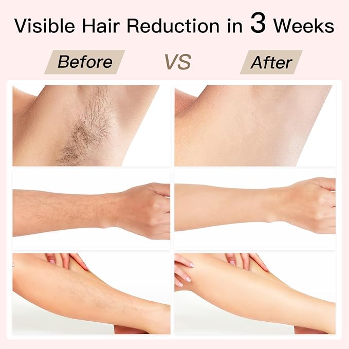 Laser Hair Removal, BoSidin IPL Hair Removal with Painless Ice-Cooling, 2-in-1 Face SR Rejuvenation, 6+1 Modes, 6 Levels Hair Removal for Women Permanent, Laser Hair Removal Kit with Shaver, Goggles
