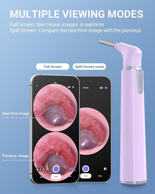 ScopeAround Otoscope with Light, Ear Camera with Dual View, 720pHD WiFi Ear Scope with 6 LED Lights, 3.9mm Lens Otoscope Camera for Kids and Adults, Ear Scope Compatible w/iPhone and Android Pink