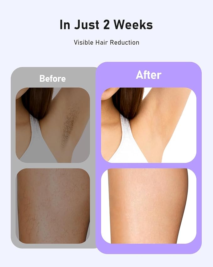 LYSMOSKI Laser Hair Removal for Women and Men, At-Home IPL Hair Removal Device with 5.2 cm² Treatment Window, Nearly Painless, Visible Results in 2 Weeks, Full Body Treatment in 8 Minutes,Purple