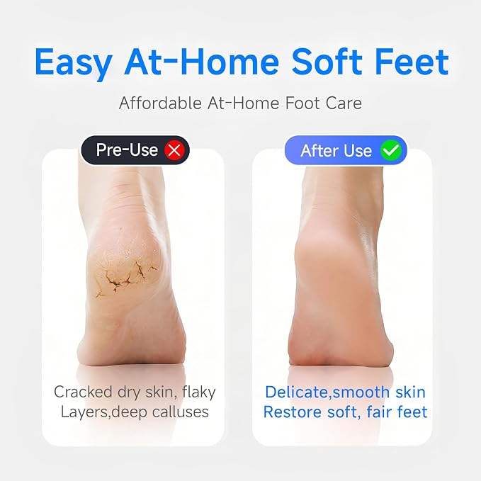 Electric Foot Callus Remover with 30000Pa Motor & 304 Stainless Steel Head – 3-Speed Rechargeable Foot File, LED Display, Gravity Sensor, IPX6 Waterproof Pedicure Tool for Dry Cracked Feet