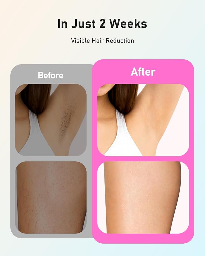 LYSMOSKI Laser Hair Removal for Women and Men, At-Home IPL Hair Removal Device with 5.2 cm² Treatment Window, Nearly Painless, Visible Results in 2 Weeks, Full Body Treatment in 8 Minutes,Pink