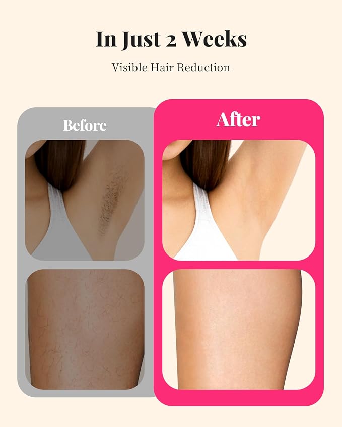 LYSMOSKI Laser Hair Removal for Women and Men, At-Home IPL Hair Removal Device with 5.2 cm² Treatment Window, Nearly Painless, Visible Results in 2 Weeks, Full Body Treatment in 8 Minutes, white