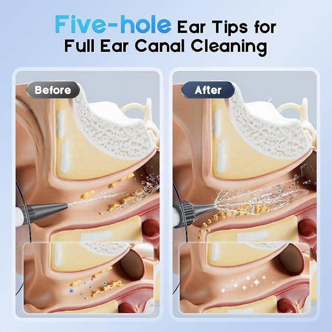 Ear Wax Removal, Electric Ear Cleaning Kit with Light, Ear Irrigation Kit with 4 Pressure Modes, Safe and Effective Ear Flush Kit with Ear Cleaner - Includes Basin, Towel & 12 Tips, (White)