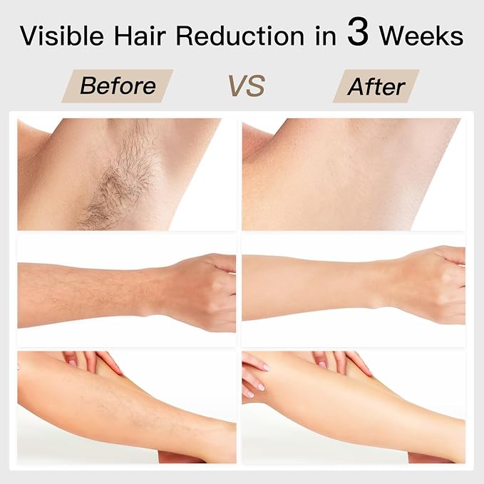 Laser Hair Removal, BoSidin IPL Hair Removal with Painless Ice-Cooling, 2-in-1 Face SR Rejuvenation, 6+1 Modes, 6 Levels Hair Removal for Women Permanent, Laser Hair Removal Kit with Shaver, Goggles