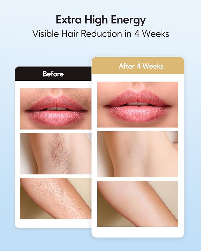 INNZA IPL Hair Removal with Ice Cooling Care Function for Women and Men,Long-Lasting Results, Painless Hair Removal, Hair Removal Device for Full Body