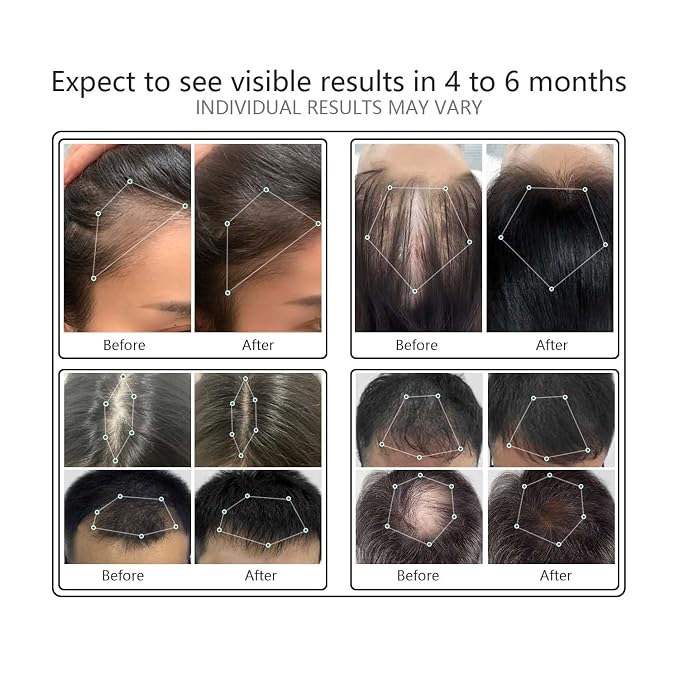 Laser Comb, FDA Cleared Device, Red Light Therapy for Hair Growth, Professional Grade Hair Loss Treatment, Regrows Fuller and Thicker Hair, Reverses Thinning, Stimulates Growth for Men & Women