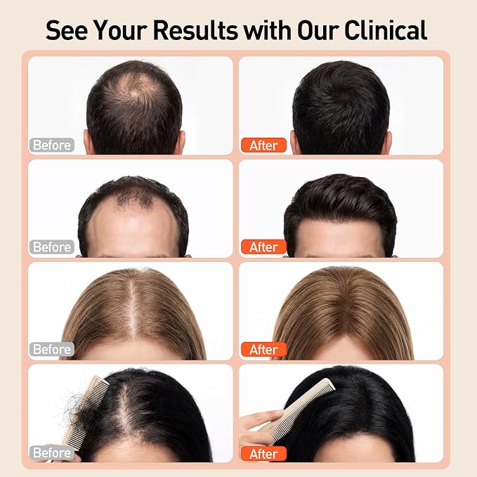 Red Light Therapy for Hair Growth with 660nm & 850nm Wavelength,Laser Hair Growth Cap with Adjustable Light Levels, Wireless and Rechargeable Hair Regrowth Cap for Men and Women