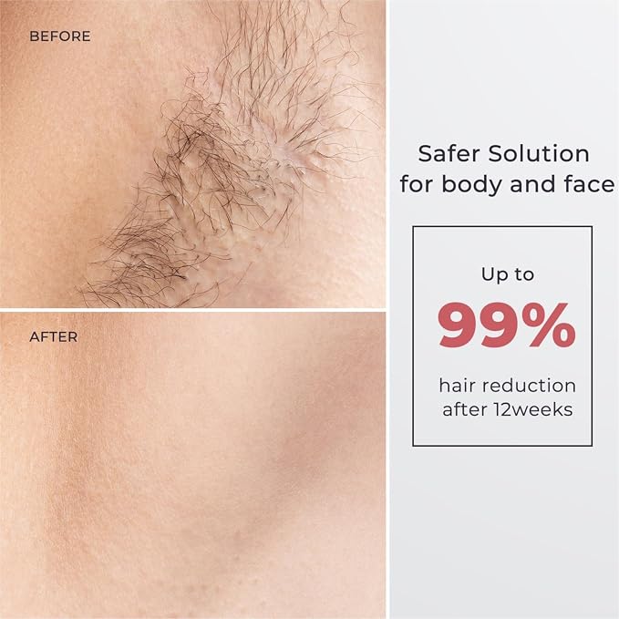 IPL Laser Hair Removal for Women and Men, Hair Removal with Ice-Cooling for Nearly Painless and Long-Lasting Result At-Home Permanent Hair Removal Device 999900 Flashes for Whole Body Use