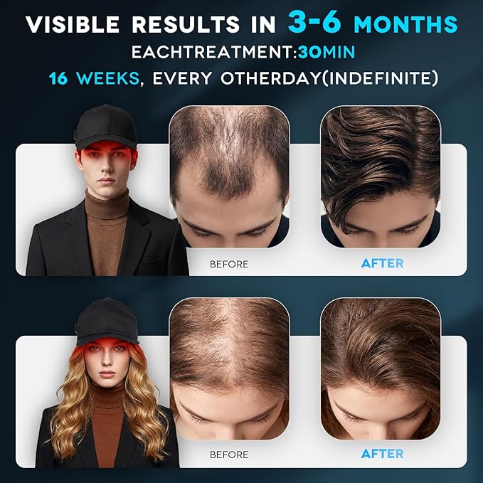 Wireless Rechargeable Red Light Therapy for Hair Growth – FDA Cleared Laser Cap for Hair Regrowth. Treats Hair Loss, Thinning & Alopecia for Men & Women