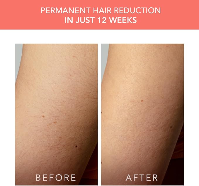 FOREO Peach 2 go IPL Hair Removal Device - Travel-Friendly Permanent Hair Removal - Laser Hair Removal - Body & Face - Painless Hair Removal - Skin Cooling & Silicone Shield - Customizable - Coral