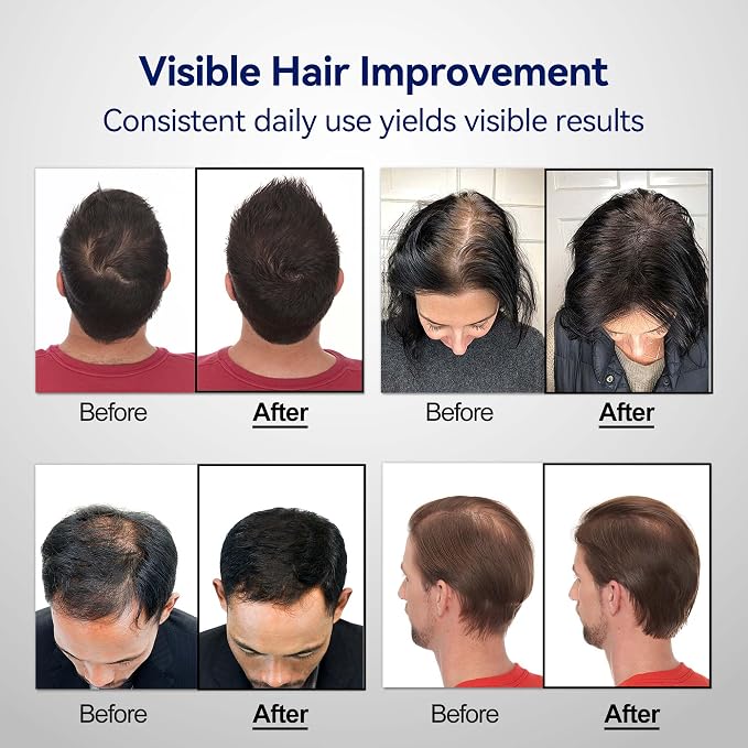 Wireless Rechargeable Red Light Therapy Cap for Hair Growth - FDA Cleared, Laser Hair Growth Device for Men and Women to Support Hair Growth