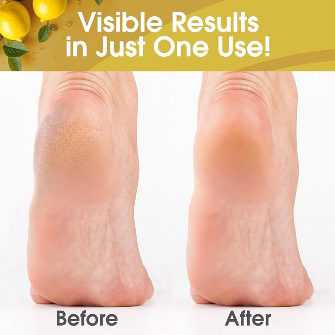 DeEnti Callus Remover for Feet, Extra Strength Foot Callus Remover Gel, 128oz Salon Grade Home Pedicure Supplies for Dry Skin, Cracked Heel, Professional Strength Foot Care, Lemon