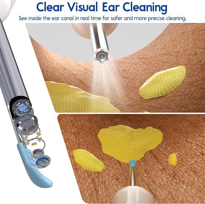 Ear Cleaner with Camera, Wireless Ear Wax Removal Tool with Screen, Visual Ear Cleaner Kit with Tweezers and Replacement Tips, Safe Ear Cleaning Tool for Kids & Adults